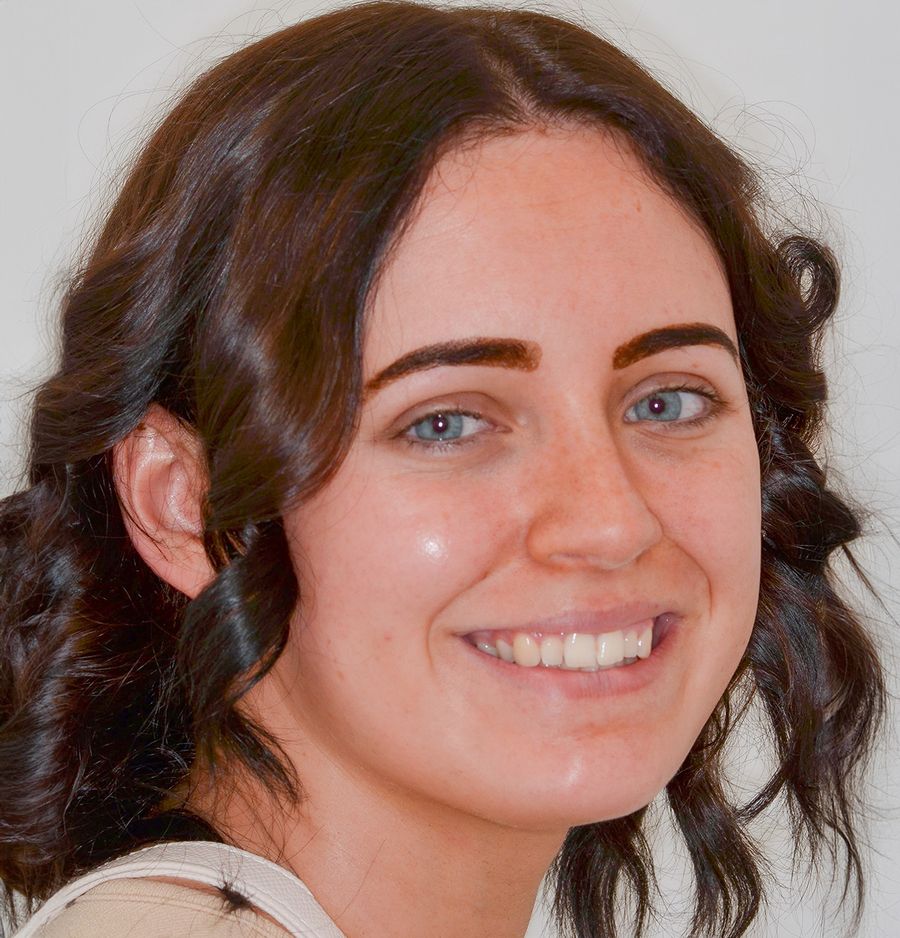 Braces & Bonding - Laura Hartford - Before